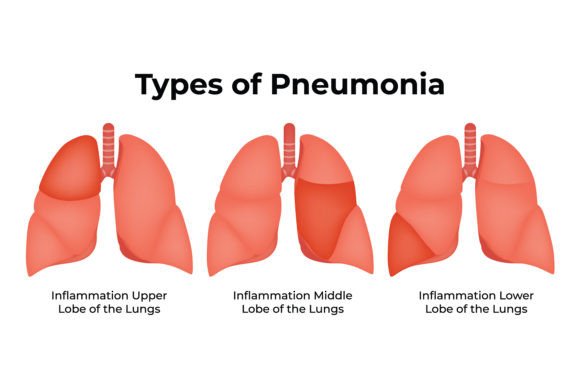 Download Types of Pneumonia Science Design Vector - Vector Collection